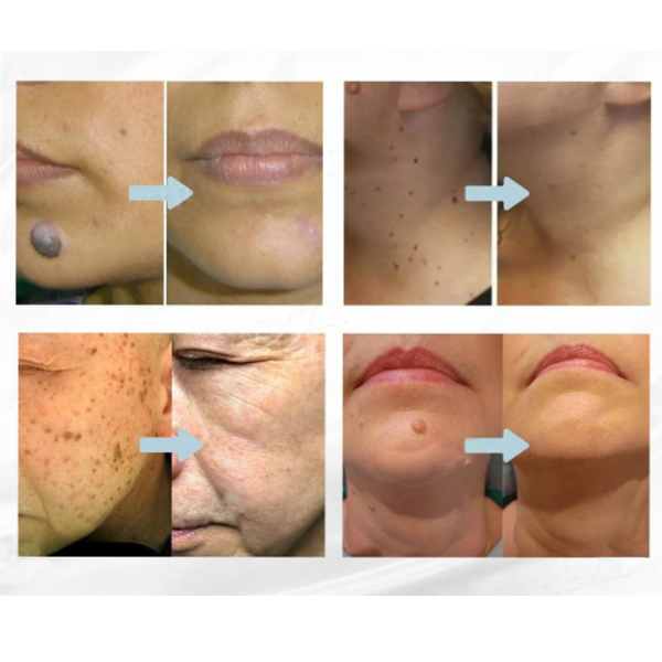 Microneedle Skin Tag Patch - 14-Day Clear Skin
