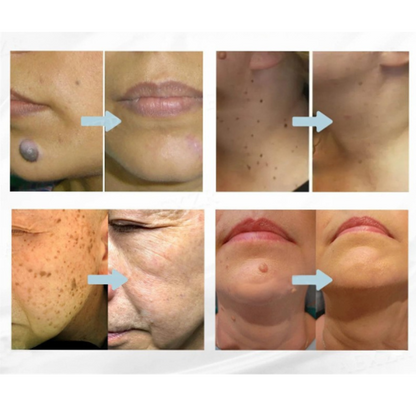 Microneedle Skin Tag Patch - 14-Day Clear Skin